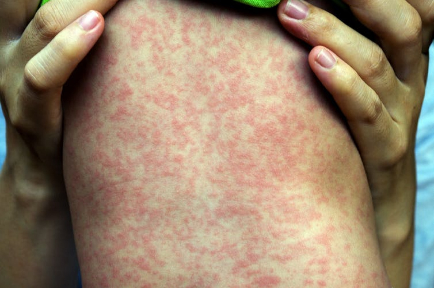 Preventive measures taken for measles